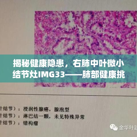 揭秘健康隐患，右肺中叶微小结节灶IMG33——肺部健康挑战详解